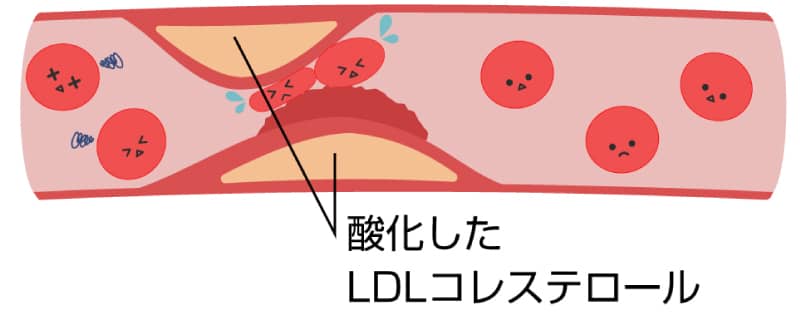 酸化したLDLコレステロール